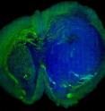 This image of a human glioblastoma brain tumor in the brain of a mouse was made with stimulated Raman scattering, or SRS, microscopy. The technique allows the tumor (blue) to be easily distinguished from normal tissue (green) based on faint signals emitted by tissue with different cellular structures