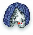 This is a brain image showing in orange/red one area of the brain where the natural painkiller (opioid) system was highly active in research volunteers who are experiencing social rejection. This region, called the amygdala, was one of several where the U-M team recorded the first images of this system responding to social pain, not just physical pain. Studying this response, and the variation between people, could aid understanding of depression and anxiety.