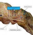 This is an image of a right knee after a full dissection of the anterolateral ligament.