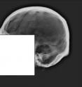 This X-ray image shows the cranial vault outline of a skull. A recent study from NC State forensic anthropologists found that even forensic experts have a hard time making a positive identification of human remains based on the shape of the vault outline.