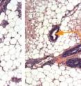 Milk ducts in cancer-prone mice are packed with tumor cells (deep purple cells, shown by arrow), causing the ducts to grow fatter. But milk ducts in mice treated with a gene-silencing nanoparticle remain mostly hollow (right, shown by arrows), like healthy ducts.