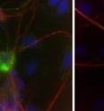 Astrocytes from ALS patients release a toxin that kills human motor neurons. The left side of the image shows a disintegrating motor neuron on top of human astrocytes (blue). The right side of the image shows a healthy motor neuron on top of astrocytes from people unaffected by ALS.