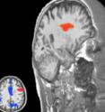 These fMRI scans show brain regions activated by sexual desire (in blue) compared to love (in pink) in healthy patients. The overlap in red illustrates how a patient's brain lesion affected the area in the brain associated with decision-making in love.