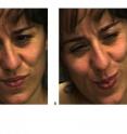 Which expression do you think shows real pain? Attempts to fake expressions of pain typically involve the same facial muscles that are contracted during real pain.  There is no telltale facial muscle whose presence or absence would indicate real or faked pain.  The difference is in the dynamics. Human observers are at chance for telling them apart. The machine learning and computer vision system described by Bartlett et al. detects faked pain significantly better than humans. The system detects distinctive dynamic features of expression missed by humans. Spontaneous and deliberate facial movement is controlled by distinct motor pathways that differ in their dynamics. By revealing the dynamics of facial action through machine vision systems, the approach in Bartlett et al has the potential to elucidate behavioral fingerprints of neural control systems involved in emotional signaling. The real expression of pain is image B on the right.