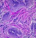 sox2/lkb1 lung tumors have characteristic squamous cell histology.