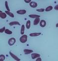 This image depicts the magnified blood of a patient with severe sickle cell disease.