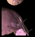 This is a 3-D reconstruction of skull compound fracture and endocranial surface changes. This is a 3-D reconstruction of skull compound fracture and endocranial surface changes.