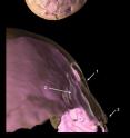 This is a 3-D reconstruction of skull compound fracture and endocranial surface changes.