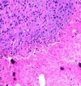 This is a hematoxylin and eosin stain of a <i>C. novyi</i>-NT treated dog tumor. Lighter pink areas areas denote tumor necrosis next to areas with viable tumor cells. Black patches are calcified areas of tissue.