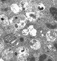 In a B cell from a mouse that mimics symptoms of mucolipidosis II patients, lysosomes are packed with undigested material.