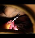 This is a demonstration of magnetic retractor lifting a liver.