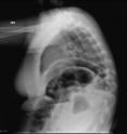 This blurred X-ray illustrates how movement can affect X-ray images and require that further images be taken. A new imaging approach that incorporates Xbox gaming technology alerts X-ray technicians to factors that could compromise image quality, thus cutting down on the number of X-rays needed and, consequently, patient exposure to radiation.
