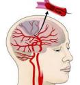 Ischemic stroke occurs when a brain blood vessel gets blocked. The gray area represents brain tissue that is not receiving nutrients as a result of the stroke.