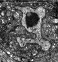 This dying worm linker cell, captured by electron microscopy, has features in common with neurons that expire prematurely due to neurodegenerative disease.