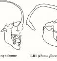 Profiles of the midline of the skull as seen in an x-ray or CT scan for people with and without Down syndrome as well as LB1, the type specimen of Homo floresiensis. The differences between the two groups of humans are minor compared to the very distinct shape of LB1.