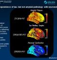 This image shows topographical correspondence of tau- but not amyloid-pathology with neuronal dysfunction in Alzheimer's disease. Right lateral surface of projected z-score images, reflecting deviation from healthy controls. Yellow/red: higher uptake, blue: lower uptake as compared to controls.