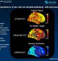 This image shows topographical correspondence of tau- but not amyloid-pathology with neuronal dysfunction in Alzheimer's disease. Right lateral surface of projected z-score images, reflecting deviation from healthy controls. Yellow/red: higher uptake, blue: lower uptake as compared to controls.