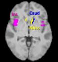 Areas of the brain associated with food cravings. The areas marked in blue and yellow -- called the caudate and the nucleus accumbens -- showed reduced activation to high-calorie foods when the volunteers took the propionate food supplement.