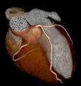 Researchers used cardiac CT scans to detect signs of subclinical coronary artery disease.