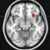 If a patient's pre-treatment resting brain activity was low in the front part of the insula, on the right side of the brain (red area where green lines converge), it signaled a significantly higher likelihood of remission with CBT and a poor response to escitalopram. Conversely, hyperactivity in the insula predicted remission with escitalopram and a poor response to CBT. Picture shows PET data superimposed on anatomic MRI scan data.