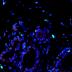 In healthy breast tissue, the percentage of cells expressing molecular marker Ki67 (green) and p27 (red) was low.