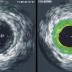 This image shows the narrowing of the arteries shown on the ultrasound. The green color indicates the plaque area.