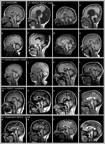 Normal Birth Pictures on This Image Shows Mri Scans Of Normal Patients  A  B  And Patients With