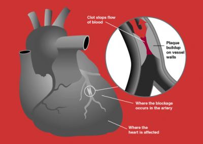 Cholesterol Heart Disease