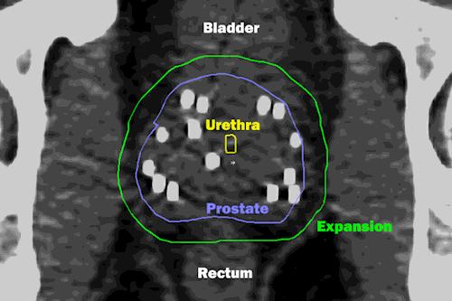 radium prostate cancer