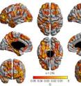 Areas in the brain where there is an association between general cognitive ability and cortical thickness. Areas in the brain where there is an association between general cognitive ability and cortical thickness.
