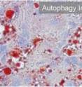 The inability to activate autophagy (right) results in massive accumulation of fat (shown here in red) in the liver. Nuclei of hepatocytes are stained in blue.