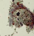 On the left is a healthy macrophage cell with sufficient vitamin D. On the right is a macrophage with inadequate vitamin D has become clogged with cholesterol, an early marker of atherosclerosis.