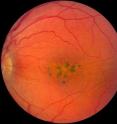 Scientists at the University of Iowa recently found a new inherited eye disease that affects the macula, which is part of the retina. In this image of the macula of an affected person, there are brown spots and cysts that cause blurring or blind spots in the person's vision.