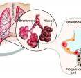 Stanford researchers use single cell genomics analysis (left) to reverse engineer the development of alveolar sacs in the lung (right). Alveoli are small balloon-like structures at the tips of the airways, where the gas exchange between our blood and the outside air occurs: blood vessels receive oxygen and deliver carbon dioxide. Alveoli are composed of two functionally very different cell types: Alveolar type I cells, the flattest cells in our body, facilitate gas exchange, whereas alveolar type II cells protect alveoli by secreting surfactants. The scientists found that both cell types arise from a single precursor, or 'progenitor,' cell during alveolar development. On the left, the experimental process is laid out: the scientists digested lung tissue to obtain single lung cells in suspension. They then captured individual cells in different chambers on a microfluidic chip. Finally, they measured which genes were active in each single cell at that moment using single cell mRNA sequencing.