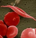 This is a scanning electron micrograph of sickled and other red blood cells.