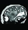 This is a magnetic resonance image (MRI) of the fetal brain in a Zika virus infected primate. The large white region is abnormal and indicates an accumulation of fluid in the brain.